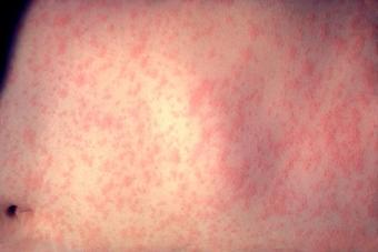 Measles rash with red bumps